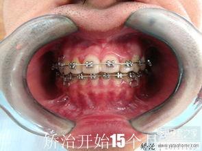 国外成人拔牙视频大全,全方位视频大全解析